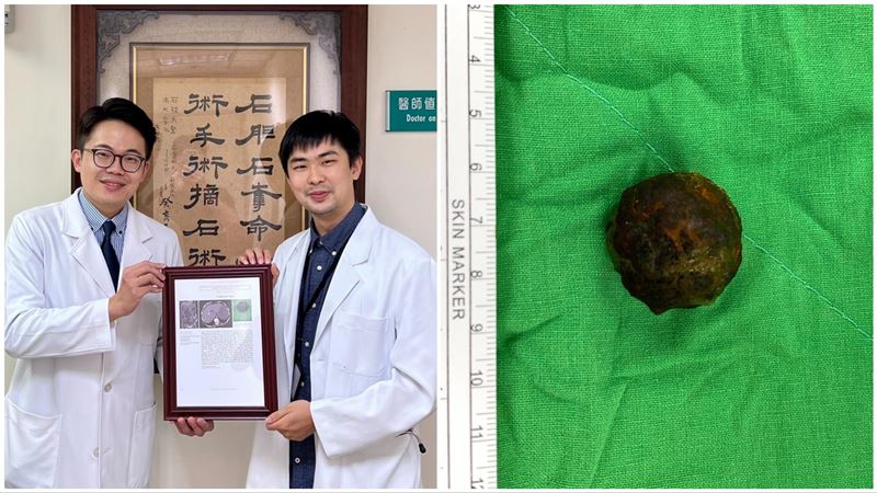 台灣嬤登國際頂尖期刊　故事從膽結石說起