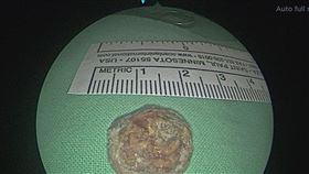 10年鼻血流不停！一查「牙齒」竟長進鼻腔（圖／翻攝畫面）