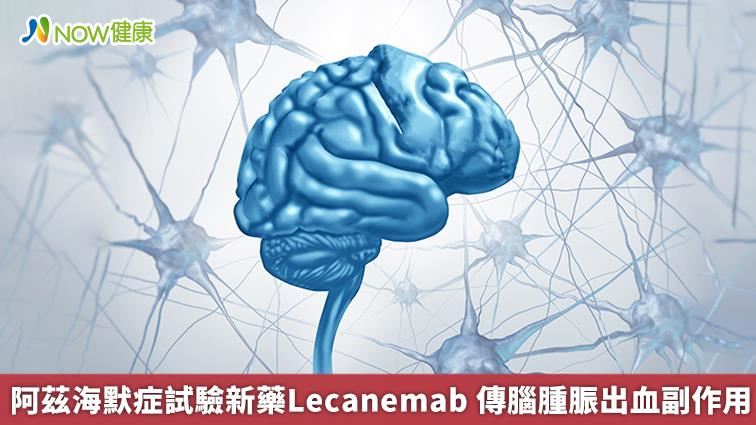 阿茲海默症新藥Lecanemab傳腦腫脤副作用
