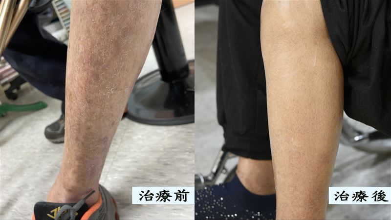 「腿飄屑屑」阿嬤狂做這事慘：癢還流湯　
