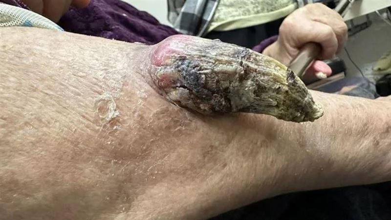 皮膚會長「怪角」　膚白50歲以上得當心
