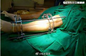 嫌154公分太矮！正妹斷骨增高術後…哭了（圖／翻攝自微博）