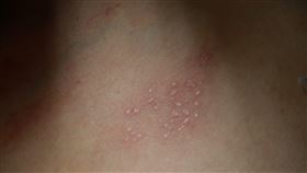 忽略這事…爸染皮蛇害不到1歲女兒長水痘　妻後來也中鏢！（圖／台中慈院提供）