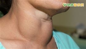 甲狀腺癌占女性十大癌症中第四名，根據衛生福利部統計，109年的甲狀腺癌年增率大約有8.5%，跟首位乳癌幾乎並列第一，顯見這幾年的增加速度快。