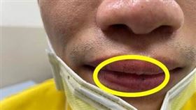 豐原醫院肝膽腸胃科王柏政醫師，黑斑瘜肉症候群，嘴唇，手指，大腸癌，(圖／署立豐原醫院提供)