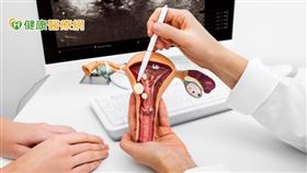 多發性肌瘤容易復發，通常醫師都會建議將子宮切除，但如果病人有生育需求，可以利用達文西手術將肌瘤一個一個移除，並保留子宮，達到病人的需求。