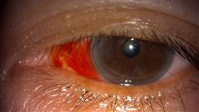 上廁所用力過度，恐造成眼球微血管破裂。（圖／萬芳醫院提供）