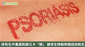 名家／紀景琪教授說明，乾癬為身體發炎反應，生物製劑是利用單株抗體抑制發炎反應的原理，達到阻斷目標。（勿用）