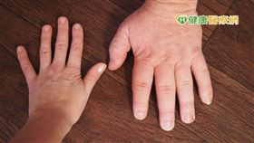 肢端肥大症最常見的發病年齡約為40至50歲，通常這時患者都已發現身體異常情況因而就醫。