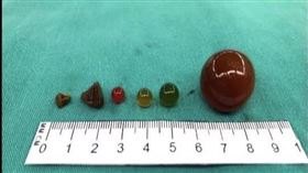 水晶寶寶,腸道阻塞,腸道壞死,高雄長庚醫院