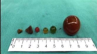 可愛東西化身死神　1歲童差點爆腸亡