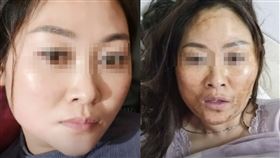 疫情,黑臉,脫皮,毀容,發燒,面膜