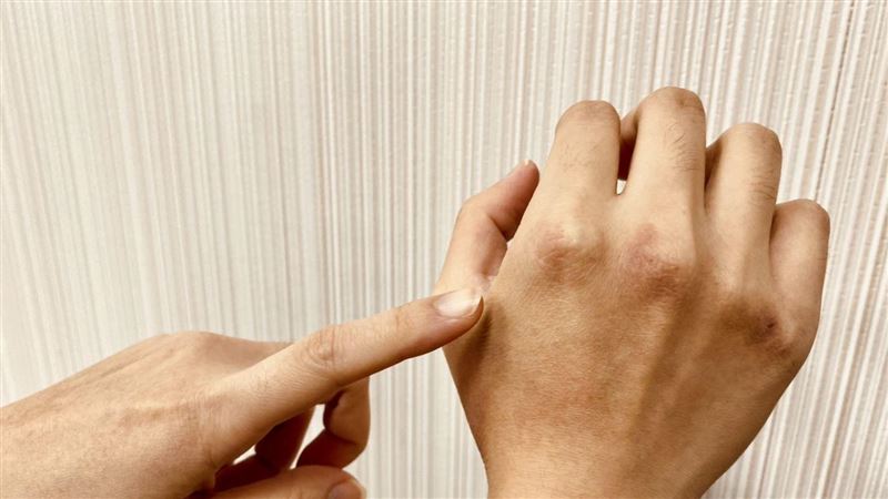 天冷「凍傷」多1倍　醫：「凹豆咖」最多