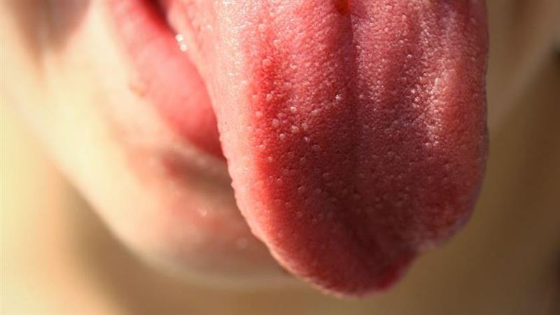 舌頭歪一邊　醫赫見血淋淋「紅燒獅子頭」