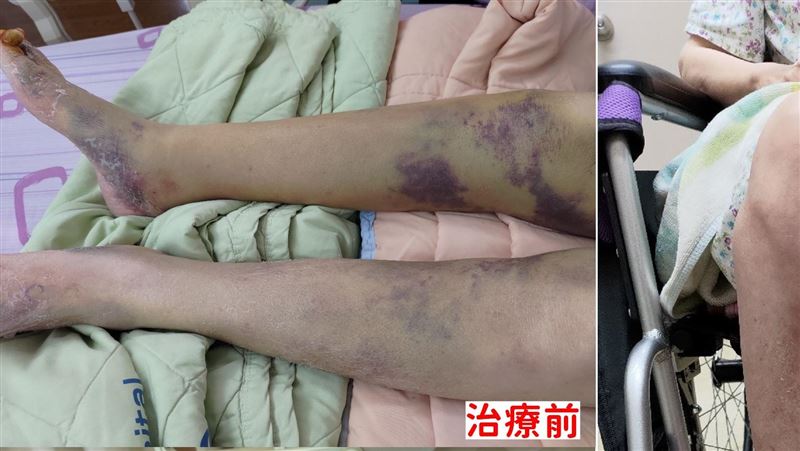 看電視坐一整天　下肢驚變「喪屍腿」