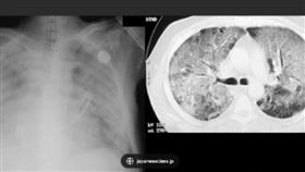 ▲中國／多確診者驚見恐怖「白肺」！中國強調：與原始病毒株無關（圖／翻攝自微博）