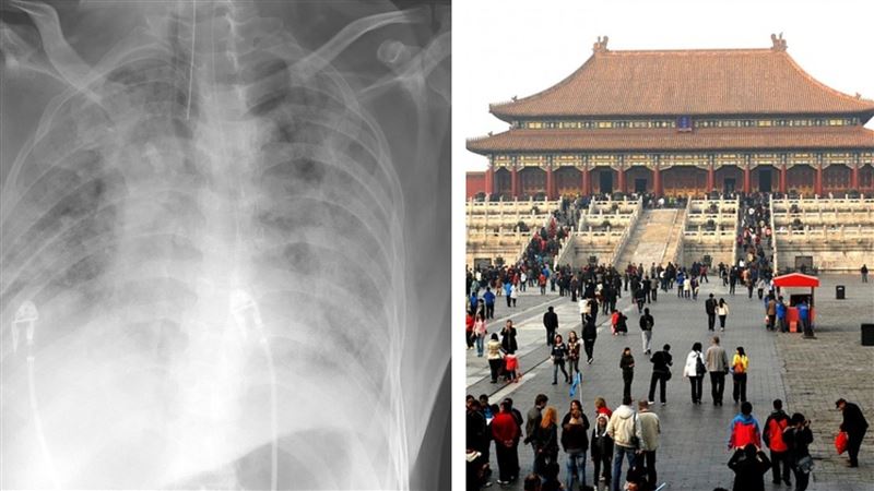台商確診大白肺　醫嘆：留在中國死路一條