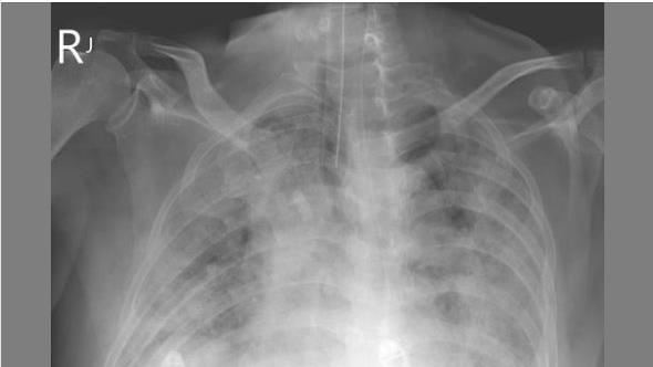 氧氣用到100%！台商「大白肺」死亡率4成