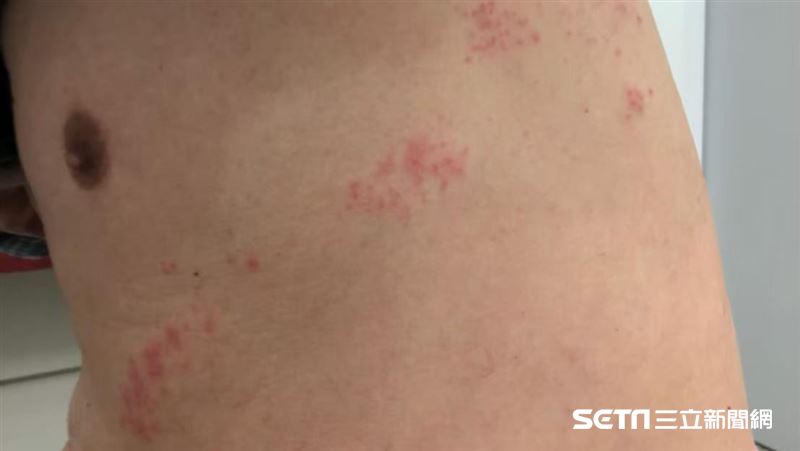 病人在皮蛇上「畫腳」　醫聽動機哭笑不得