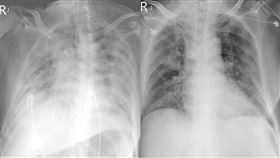  「大白肺」確診台商最新病況！他曝X光對比照：台灣醫護就是強