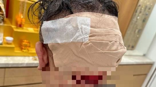 館長曝「後腦包紮」滲血照　網驚：出事？