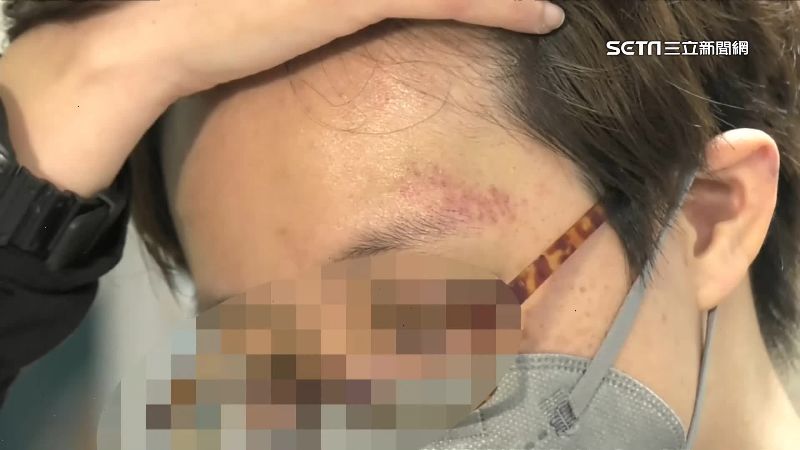 護理師莫名遭暴打　後腦杓、額頭紅腫瘀青