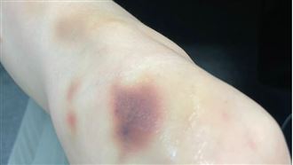 他常瘀青！車禍血流不止竟罹患「這疾病」