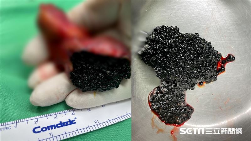 有圖慎入！婦膽囊切除驚見爆滿「魚子醬」