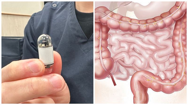 小腸6公尺怎麼檢查？「膠囊」一吞看光光