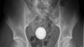 澳洲有少年將高爾夫球塞入體內。（圖／翻攝自外科病例報告）