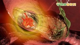 胰臟在腸胃道後方，檢查不易又有腹膜包覆，患者對於疼痛或病變感受不明顯，也常誤以為是腸胃不適，導致出現飯後腹痛、背痛等症狀，往往已是腫瘤壓迫到脾胃血管，疾病進入晚期，預後不佳。