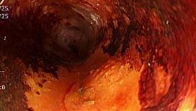 「無聲殺手」食道癌內視鏡下現形　先進手術保留消化道(安南醫院提供)