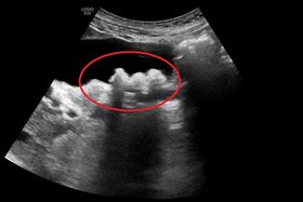 ▲膽結石堆積在膽囊裡，須經手術完整切除膽囊。（圖／台北慈濟醫院提供）

