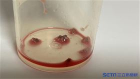 腎結石(讀者提供)