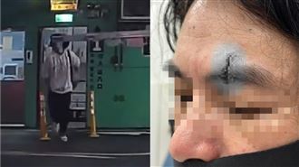 停車場「撞上天降柵欄」！他滿臉血縫8針