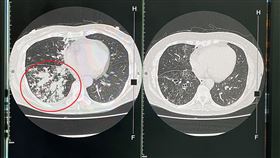 台中婦久咳暴瘦，胸悶，支氣管像爆漿香腸，細支氣管一串串葡萄，支氣管擴張症(圖／烏日林新醫院提供)