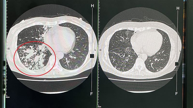 台中婦咳5年胸悶暴瘦　肺部驚見爆漿香腸