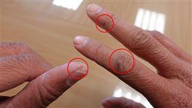 呂先生手指乾裂疼痛無法拿筆。（圖／臺中慈濟醫院提供）