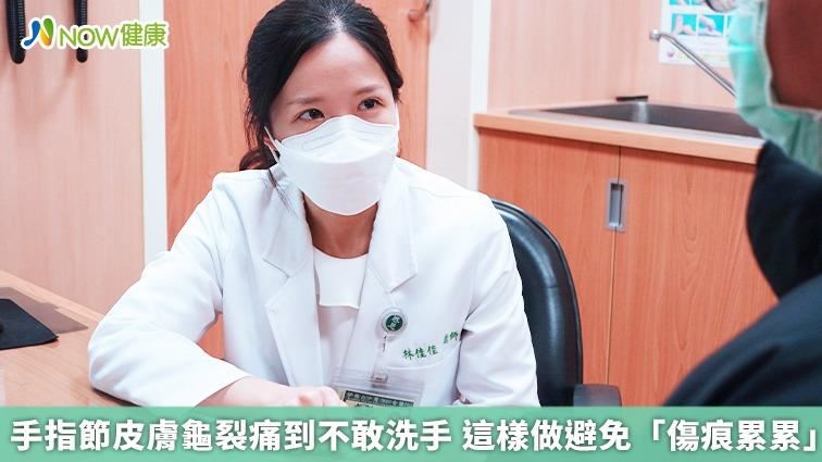 手指龜裂痛到不敢洗　這樣做避免傷痕累累