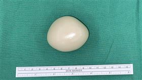 醫師表示，這個是包覆性脂肪壞死腫瘤。（圖／翻攝自《吳柏宣醫師（Po-Hsuan Wu, MD）》）