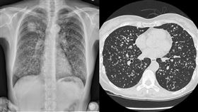 只有輕微咳嗽！醫一掃…驚見她「肺整片滿天星」嘆：到處轉移了。蘇一峰