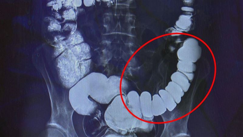 女嚴重便秘飛台灣求救！醫：把腸子逼太緊