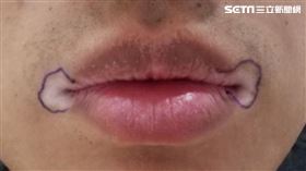 台中少年嘴角白斑症加上口罩解封，引發容貌焦慮症。吳文宏醫師。（圖／光田醫院提供）