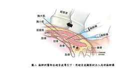 0302微創心臟手術及神經阻斷術(台北榮總提供)