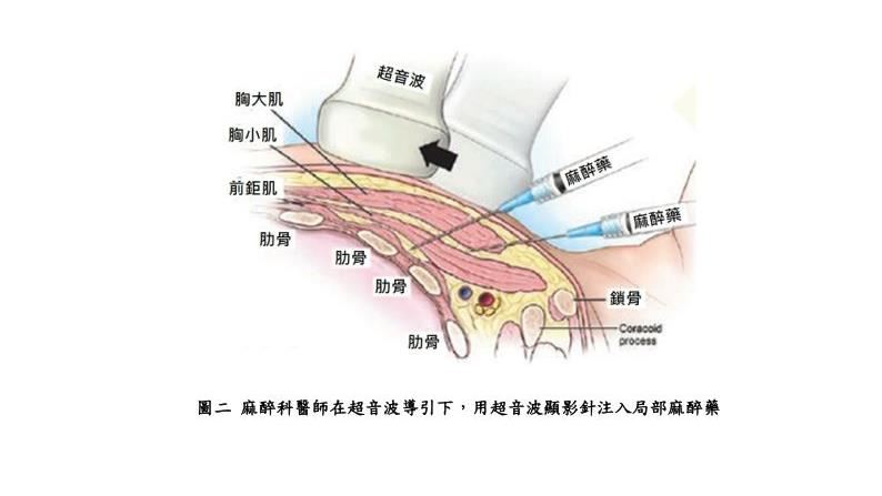 心臟微創後不劇痛!北榮揭「無痛」新方法