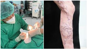 靜脈曲張(南投醫院)