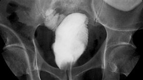 膀胱癌(慈濟醫院提供)