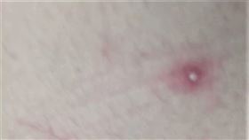 台南,猴痘,照片,大腿,痘痘（台南市衛生局提供）