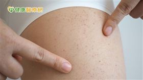 若四肢出現紅色出血小點，或嘴巴出現黑色血泡，恐為血小板低下徵兆，應及早就醫確認血球是否穩定，積極接受治療可改善存活率。