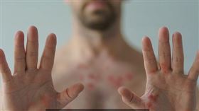 翻攝自童嵩珍老師談猴痘影片